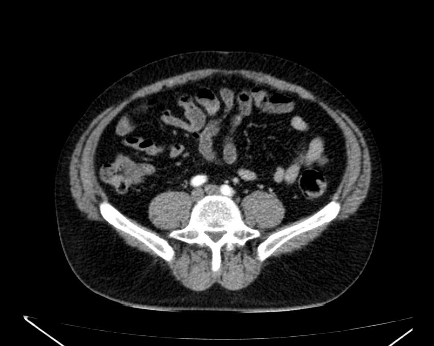 Carcinoid tumor with hepatic metastases (Radiopaedia 22651-22670 B 58).jpg