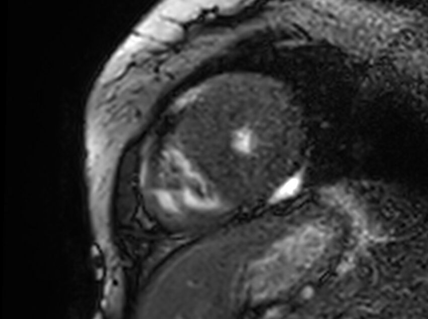 Cardiac amyloidosis (Radiopaedia 61600-69579 Short axis bSSFP 71).jpg