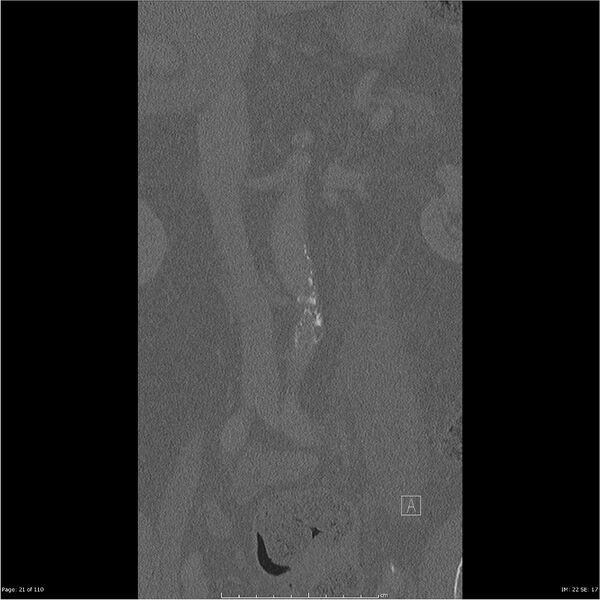 File:Cardiac trauma (Radiopaedia 32874-33858 Coronal bone window 21).jpg