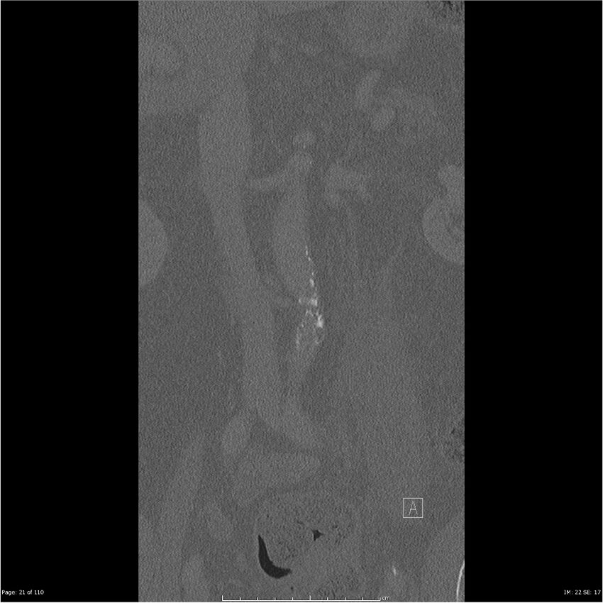 Cardiac trauma (Radiopaedia 32874-33858 Coronal bone window 21).jpg