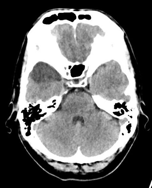 File:Carotid arterial dissection (Radiopaedia 30001-30551 Axial non-contrast 12).jpg