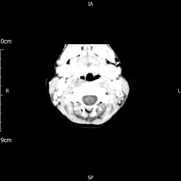 File:Cavernous sinus thrombosis (Radiopaedia 79414-92510 Axial Brain 14).jpg