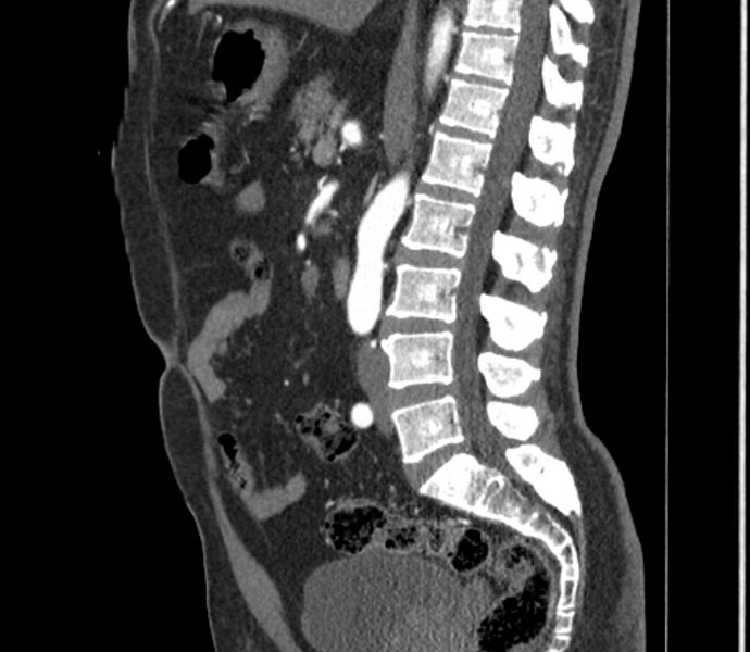 File:Celiac artery dissection (Radiopaedia 52194-58080 B 53).jpg