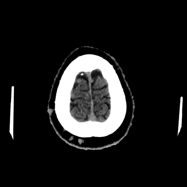 File:Central nervous system Langerhans cell histiocytosis (Radiopaedia 65728-74878 Axial non-contrast 48).jpg