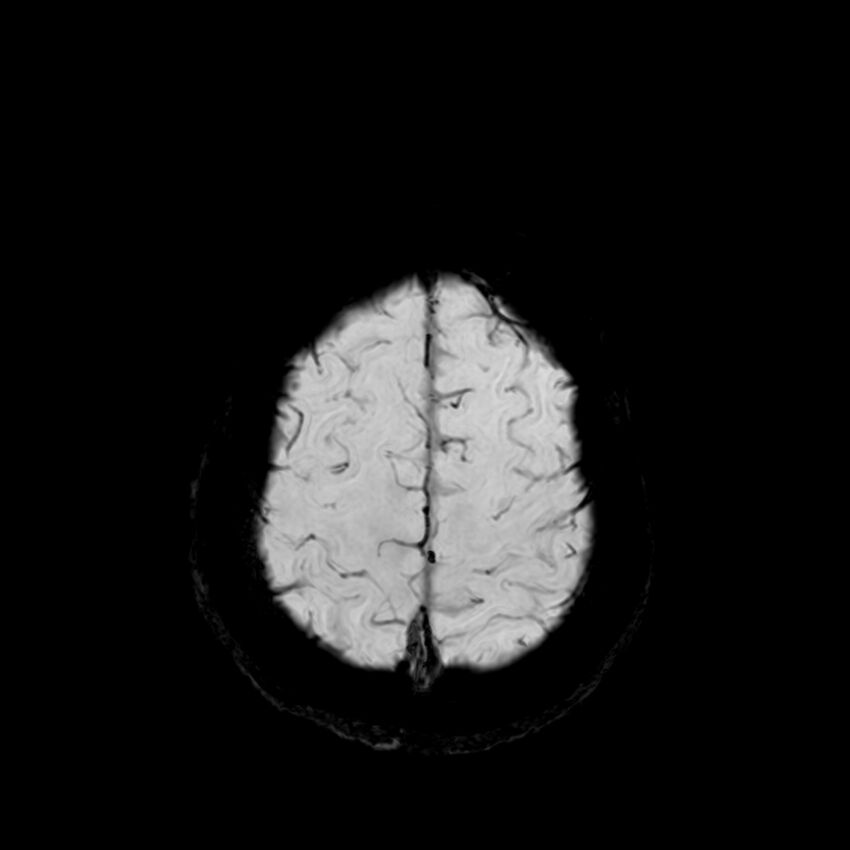 Central neurocytoma (Radiopaedia 79320-92380 Axial SWI 121).jpg