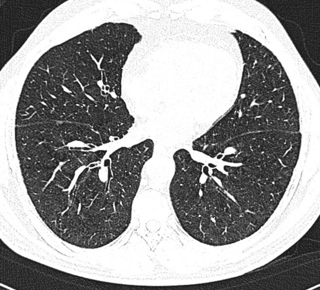 File:Centrilobular pulmonary emphysema (Radiopaedia 26808-26971 Axial lung window 25).jpg