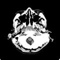 Cerebellar abscess secondary to mastoiditis (Radiopaedia 26284-26412 Axial non-contrast 13).jpg