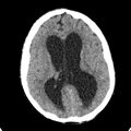 Cerebellar abscess secondary to mastoiditis (Radiopaedia 26284-26412 Axial non-contrast 90).jpg