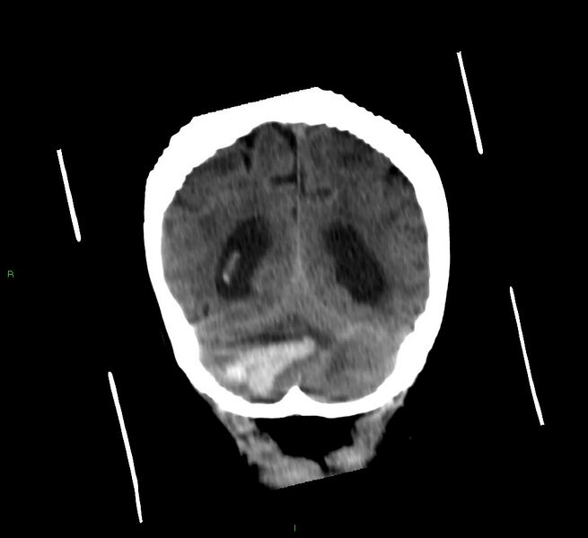 File:Cerebellar hemorrhage (Radiopaedia 58792-66026 Coronal non-contrast 20).jpg