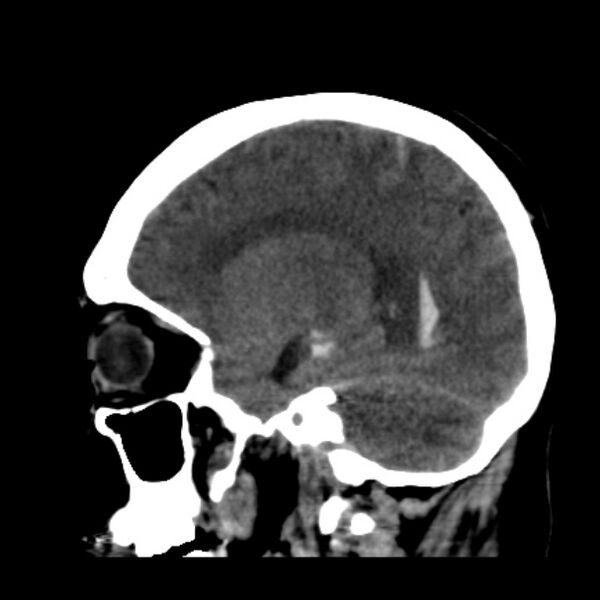 File:Cerebellar hemorrhage causing obstructive hydrocephalus (Radiopaedia 33989-35207 B 17).jpg