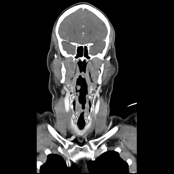File:Cerebellar infarct due to vertebral artery dissection with posterior fossa decompression (Radiopaedia 82779-97029 D 22).png
