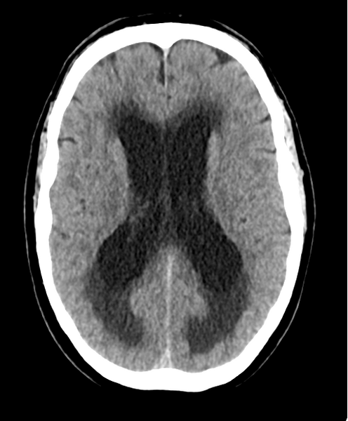 File:Cerebellar metastasis from lung adenocarcinoma (Radiopaedia 86690-102828 Axial non-contrast 17).png