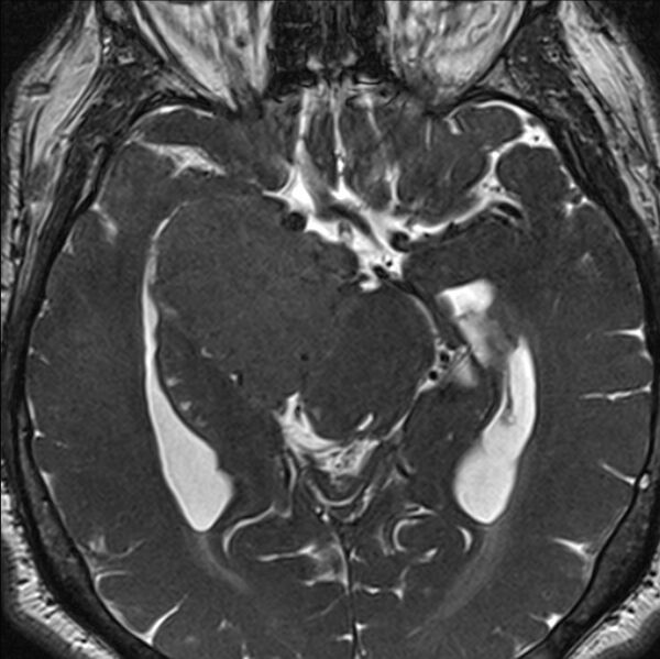 File:Cerebellopontine angle meningioma (Radiopaedia 24459-24764 I 41).jpg