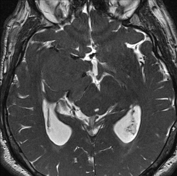 File:Cerebellopontine angle meningioma (Radiopaedia 24459-24764 I 46).jpg