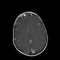 Cerebral abscess post cardiac surgery (Radiopaedia 27244-27420 Axial T1 C+ 16).jpg