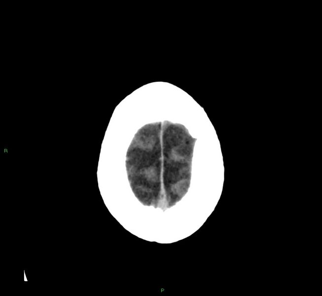 File:Cerebral amyloid angiopathy-associated lobar intracerebral hemorrhage (Radiopaedia 58376-65511 Axial non-contrast 8).jpg