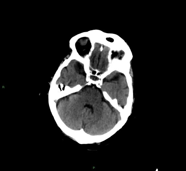 File:Cerebral amyloid angiopathy-associated lobar intracerebral hemorrhage (Radiopaedia 58377-65514 Axial non-contrast 35).jpg