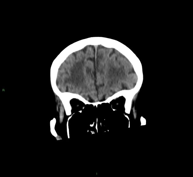 File:Cerebral amyloid angiopathy-associated lobar intracerebral hemorrhage (Radiopaedia 58530-65688 Coronal non-contrast 52).jpg
