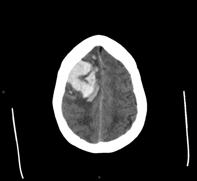 File:Cerebral amyloid angiopathy-associated lobar intracerebral hemorrhage (Radiopaedia 58560-65723 Axial non-contrast 13).jpg