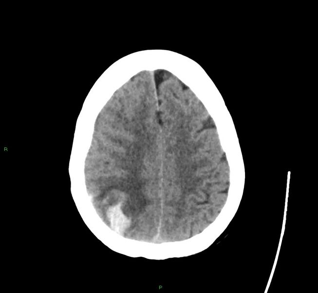 File:Cerebral amyloid angiopathy-associated lobar intracerebral hemorrhage (Radiopaedia 58563-65727 Axial non-contrast 16).jpg