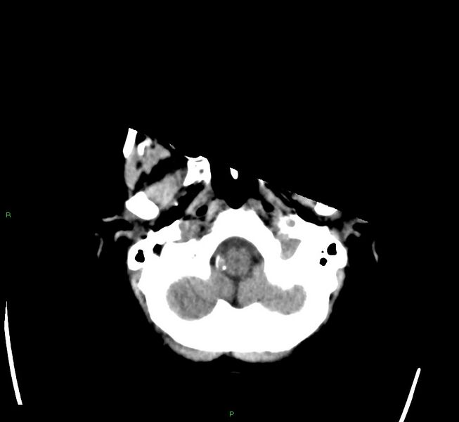 File:Cerebral amyloid angiopathy-associated lobar intracerebral hemorrhage (Radiopaedia 58563-65727 Axial non-contrast 47).jpg