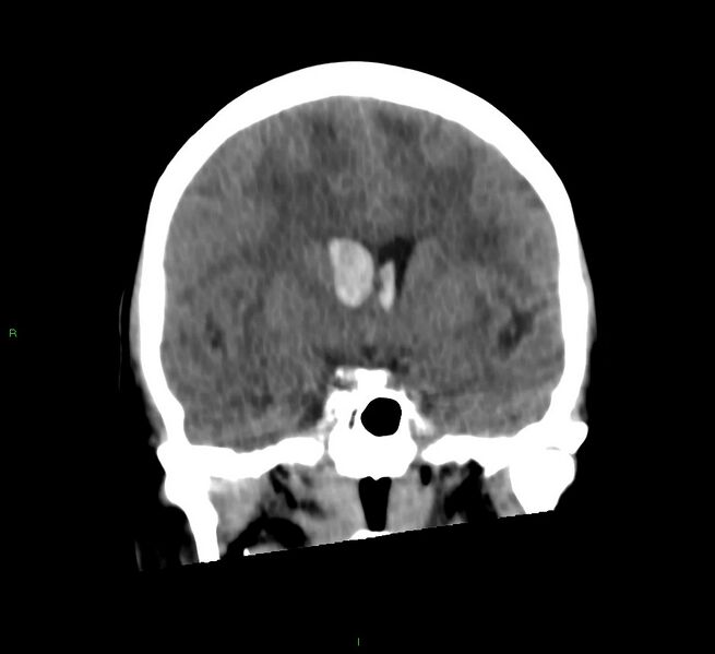 File:Cerebral amyloid angiopathy-associated lobar intracerebral hemorrhage (Radiopaedia 58566-65730 Coronal non-contrast 42).jpg