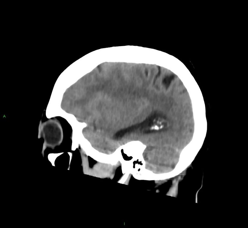 Cerebral amyloid angiopathy-associated lobar intracerebral hemorrhage (Radiopaedia 58752-65973 C 16).jpg