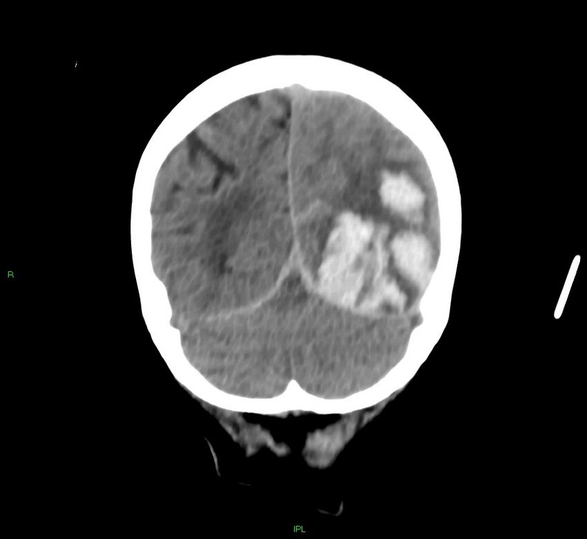 Cerebral amyloid angiopathy-associated lobar intracerebral hemorrhage (Radiopaedia 58754-65975 Coronal non-contrast 17).jpg
