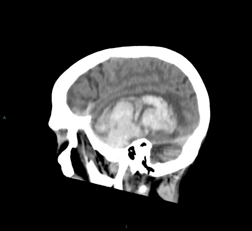 Cerebral amyloid angiopathy-associated lobar intracerebral hemorrhage (Radiopaedia 58758-65980 C 13).jpg