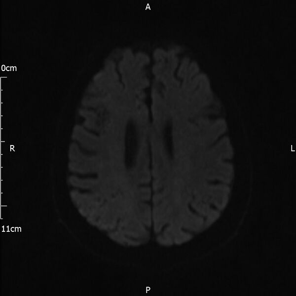 File:Cerebral amyloid angiopathy related inflammation (Radiopaedia 72772-83415 Axial DWI 62).jpg