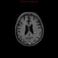 Cerebral and orbital tuberculomas (Radiopaedia 13308-13311 Axial T1 C+ 14).jpg