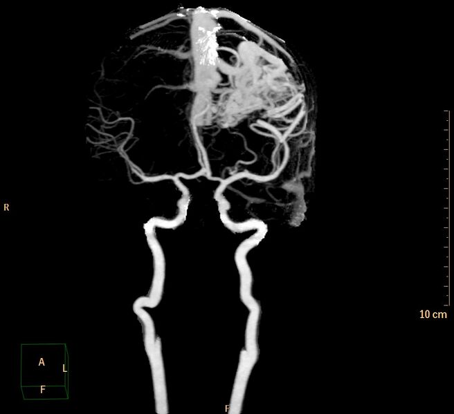 File:Cerebral arteriovenous malformation (Radiopaedia 29531-30031 3D reconstruction 1).jpg