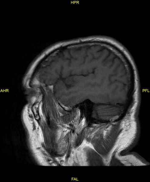 File:Cerebral autosomal dominant arteriopathy with subcortical infarcts and leukoencephalopathy (CADASIL) (Radiopaedia 86108-102054 Sagittal T1 6).jpg