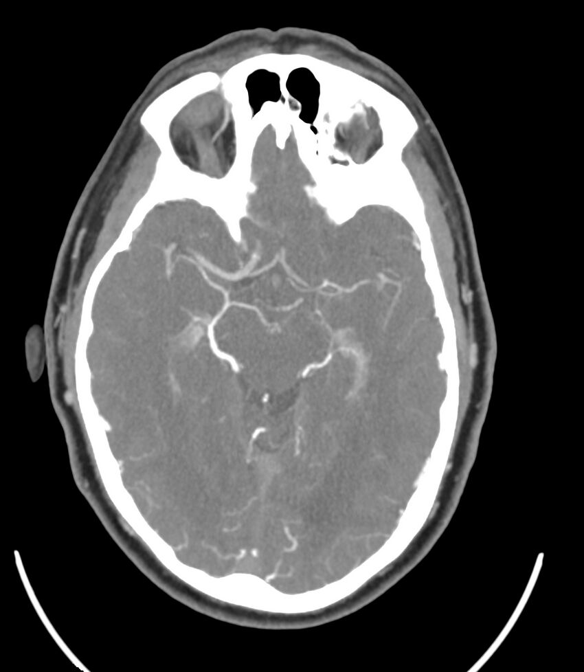 Cerebral dural venous sinus thrombosis (Radiopaedia 86514-102576 A 49).jpg