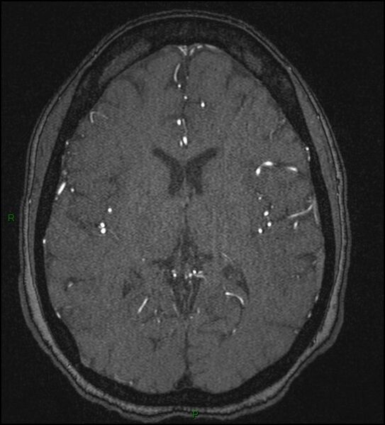 File:Cerebral fat embolism (Radiopaedia 35022-36525 Axial TOF 116).jpg