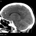 Cerebral hemorrhagic contusion with subdural and subarachnoid hemorrhage (Radiopaedia 10680-11146 C 12).jpg