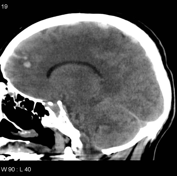 File:Cerebral hemorrhagic contusion with subdural and subarachnoid hemorrhage (Radiopaedia 10680-11146 C 12).jpg
