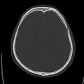 Cerebral hemorrhagic contusions (Radiopaedia 23145-23188 Axial bone window 37).jpg