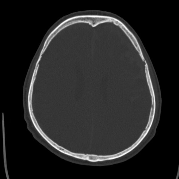 File:Cerebral hemorrhagic contusions (Radiopaedia 23145-23188 Axial bone window 37).jpg