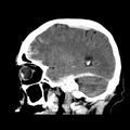Cerebral hemorrhagic contusions (Radiopaedia 23145-23188 C 14).jpg