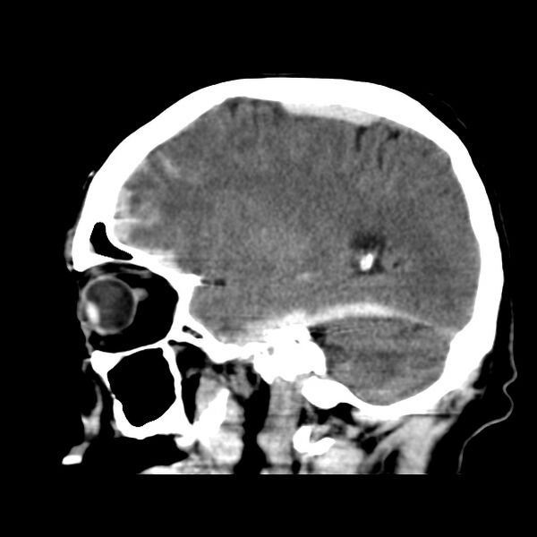 File:Cerebral hemorrhagic contusions (Radiopaedia 23145-23188 C 14).jpg