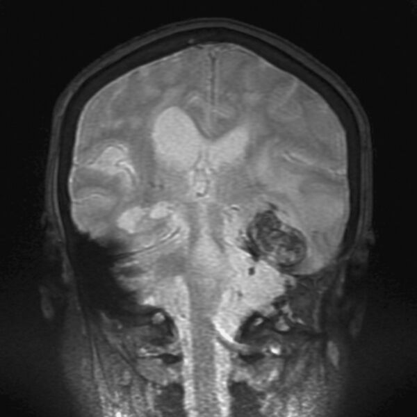 File:Cerebral radiation necrosis (Radiopaedia 7248-8188 D 1).jpg