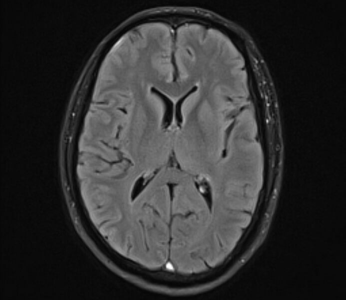 File:Cerebral venous thrombosis (Radiopaedia 71207-81504 Axial FLAIR 15).jpg