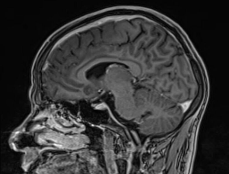 File:Cerebral venous thrombosis (Radiopaedia 71207-81504 Sagittal T1 C+ 34).jpg