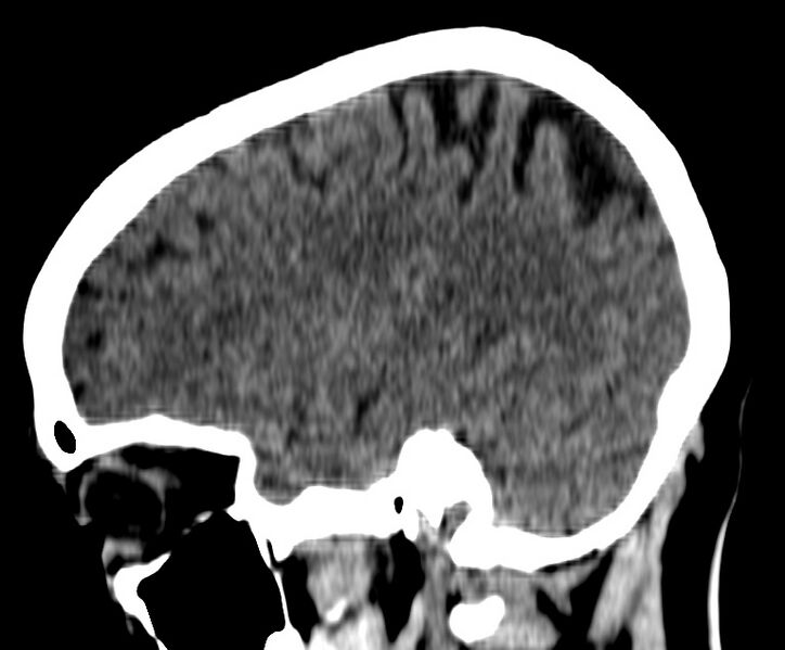 File:Cerebral venous thrombosis - CT only (Radiopaedia 41031-43778 B 8).jpg