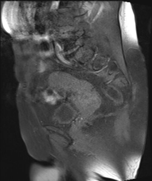 File:Cervical carcinoma (Radiopaedia 88312-104943 Sagittal T1 fat sat 19).jpg