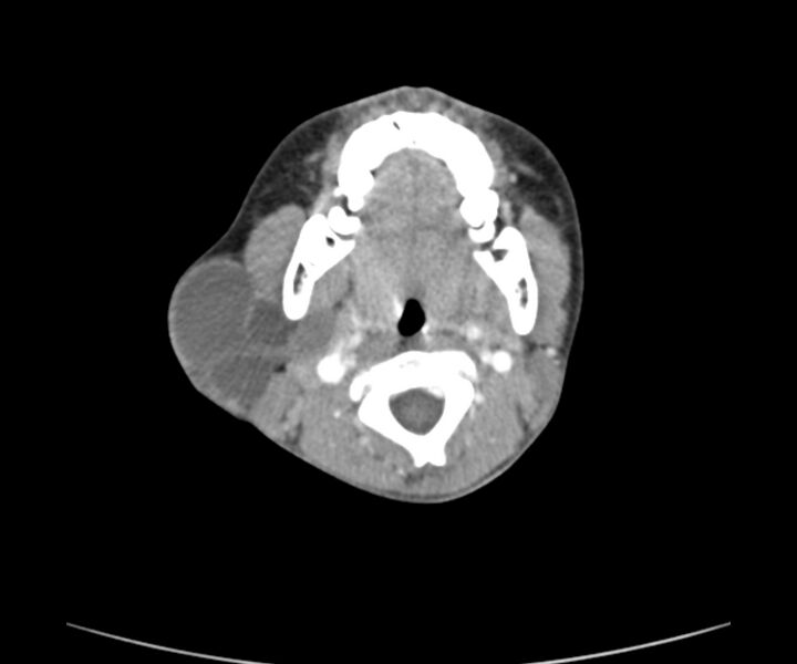 File:Cervical cystic lymphangioma (Radiopaedia 63655-72332 Axial + contrast 10).jpg