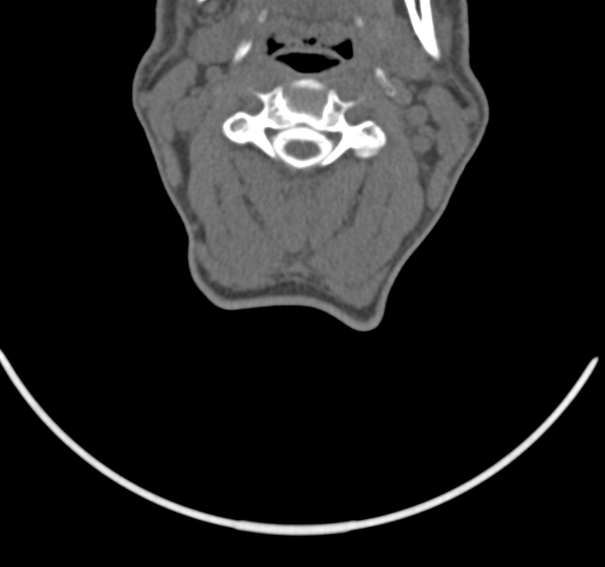 Cervical dural CSF leak on MRI and CT treated by blood patch (Radiopaedia 49748-54996 B 27).png