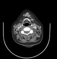 Cervical lymphadenopathy- cause unknown (Radiopaedia 22420-22457 C+ delayed 36).jpg