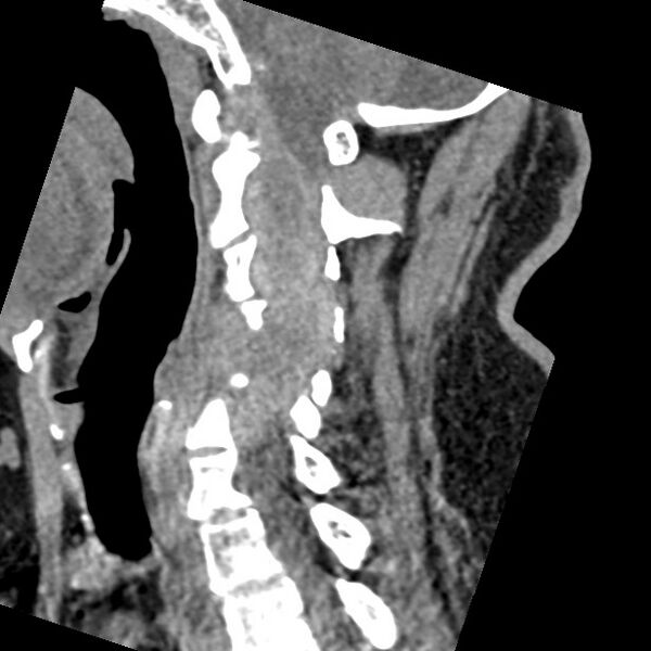 File:Cervical spinal neurofibroma in a patient with NF1 (Radiopaedia 58344-65464 C 23).jpg
